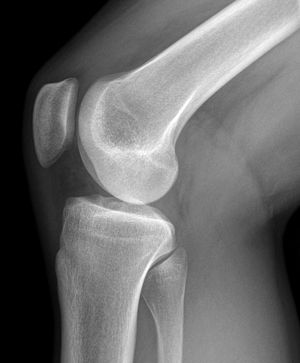 new balance minimus knee pain