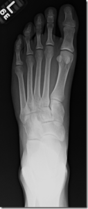 Metatarsal Stress Fractures in Runners Part II: Thoughts From a Radiologist