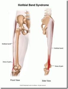 Running Shoes and Iliotibial Band Syndrome (ITBS): One Runner’s Story