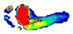 Foot Pressure Tracing