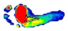 Underfoot Pressure Tracings of Forefoot, Midfoot, and Heel Strikes in Barefoot Runners: We All Supinate!